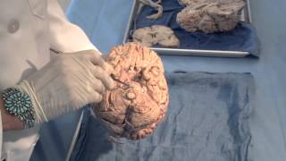 Orientation The Planes of the Brain Neuroanatomy Video Lab  Brain Dissections [upl. by Dyolf]