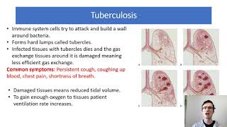 A Level Biology 33 Lung Diseases and Data [upl. by Harobed379]