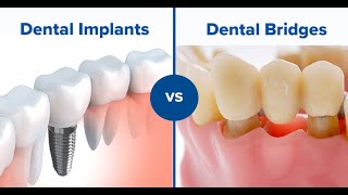 Patient Consent Video Crown Placement [upl. by Wolenik]