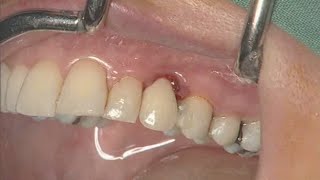 NobelActive clinical case immediate implant placement  Eric Rompen [upl. by Nywles]