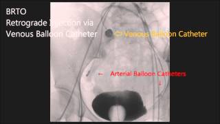 Balloonoccluded Retrograde Transvenous Obliteration for Uterine Arteriovenous Malformation [upl. by Asel238]