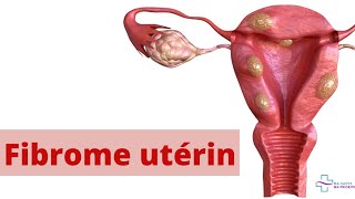 FIBROME UTERIN QUELS SONT LES CAUSES ET SYMPTOMES [upl. by Atinuahs]