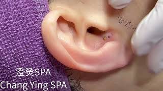 清粉刺推薦耳朵黑頭Blackheads on ear Removal 耳の角栓耳掃除 [upl. by Aidne]