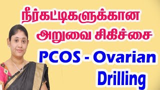 PCOS நீர்கட்டிகளுக்கான அறுவைசிகிச்சை PCOS Ovarian Drilling How To Get Pregnant with PCOS in Tamil [upl. by Kehsihba]