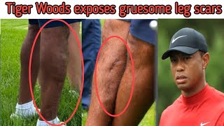 Tiger Woods exposes his gruesome leg scars from lifethreatening car crash  Tiger Woods legs [upl. by Marigolda960]