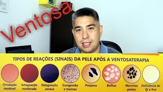 Ventosa Mini Curso de Ventosaterapia  Parte 22 [upl. by Orling17]