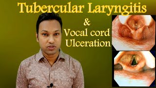 Tubercular Laryngitis । Voice Box TB । Differential Diagnoses of Vocal Cord Ulceration [upl. by Gerc708]