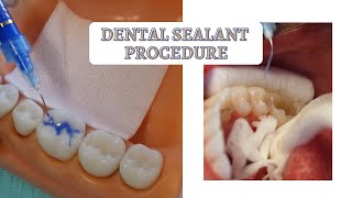 How to Apply a Dental Sealant  Wet vs Dry Environment [upl. by Olathe]