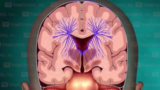 Deep Medullary Thrombosis [upl. by Lieno709]