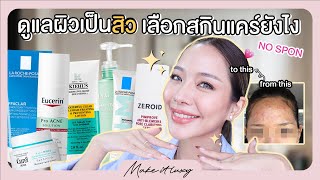 Make it luxy EP 35 l แนะนำสกินแคร์สำหรับผิวเป็นสิว ล้างหน้าMoisturizer ใช้ร่วมกับการรักษาสิวได้ [upl. by Rosen]