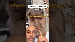 Werewolf Syndrome  Doctor Explains shorts [upl. by Huggins]