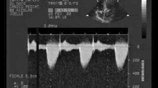 echocardiogrammultiple rhabdomyoma tumor cw doppler [upl. by Verda448]