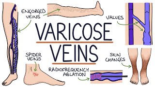 Understanding Varicose Veins [upl. by Gherlein]