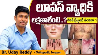 లూపస్ వ్యాధికి ట్రీట్మెంట్  Systemic Lupus Erythematosus in Telugu  Treatment Range Hospitals [upl. by Tubb]