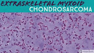 Extraskeletal Myxoid Chondrosarcoma 5Minute Pathology Pearls [upl. by Oratnek]