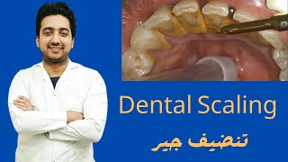 20 Years of Dental Calculus Removed with Ultrasonic Scaler  Tartar And Calculus Removal Part 1 [upl. by Savdeep70]