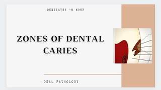 DENTAL CARIES ZONES [upl. by Suter949]