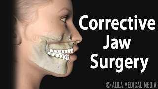 Corrective Jaw Orthognathic Surgery Animation [upl. by Aneehsor]