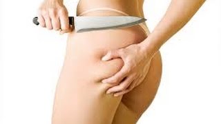 How to Get Rid of Cellulite on Thighs and Bum Naturally at Home  Cellulite Treatment and Removal [upl. by Margetts]