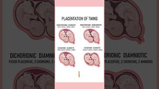 4 Types of twins medically Twin pregnancies pregnant youtubeshorts twins September 4 2024 [upl. by Nnyre]