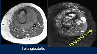 Dr Geoffrey Riley Presents 20 in 10 osteosarcoma [upl. by Hnahc810]