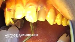 How We Fix a Chipped Tooth [upl. by Valerie696]