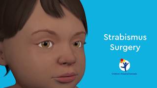 What is Strabismus Surgery [upl. by Anirtep329]