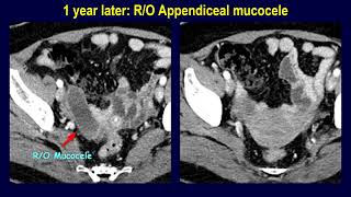 Appendiceal mucocele or mucinous neoplasm  Naming determines the management [upl. by Eak]