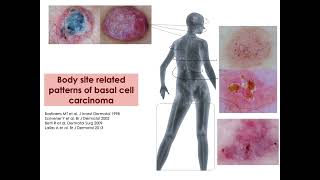 BCC dermoscopic criteria according to body site  Dr C Conforti [upl. by Woolson244]