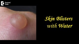 Skin Blisters with Water Causes Treatment Draining Prevention  DrAruna Prasad  Doctors Circle [upl. by Stewart]