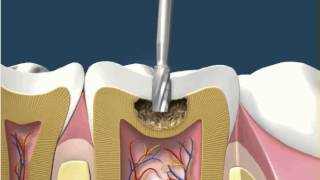 Dental Fillings White Amalgam 1 [upl. by Solenne]