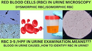 RBC IN URINE MICROSCOPYCAUSES OF RBC IN THE URINE DYSMORPHIC RBC ISOMORPHIC RBCGHOSTRBC IN URINE [upl. by Adnalay334]