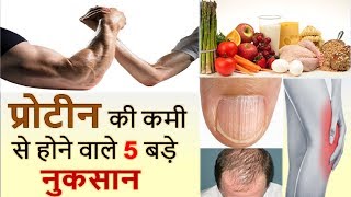 Top 5 Protein Deficiency Symptoms You Need To Know in Hindi  HEALTH JAGRAN [upl. by Ahseetal]