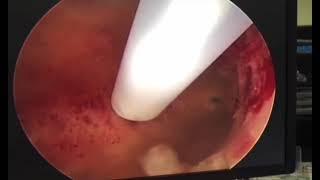 Mirena insertion live hysteroscopic view by Shawki [upl. by Neelyahs887]