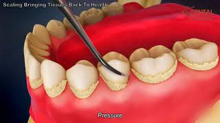 Teeth scaling to remove plaque  3d animated video  Dental Solutions Clinic Bangalore [upl. by Ecitsuj]