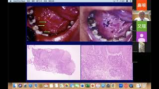 ShengPo Hao Webinar  Special EP Mon 13 May Management of Oral Cancer [upl. by Travers363]