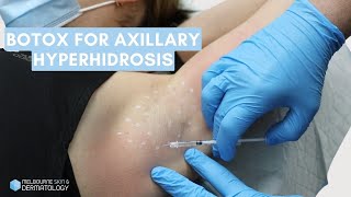 Botox for Axillary Hyperhidrosis  Melbourne Skin amp Dermatology [upl. by Rabassa]