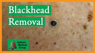 Large Blackhead Removal without Extractor Tool  Auburn Medical Group [upl. by Nylisoj]