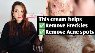 How to use Freckles removal cream to remove Pimple marks brown spots freckle melasma  Mixed Bag [upl. by Eigram]