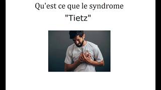 Syndrome de Tietze  Français [upl. by Canning104]