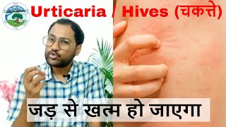 Homeopathic medicine for urticaria skin rash  skin allergy खुजली जलन चकत्ते [upl. by Yenruoj]