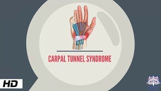 CARPAL TUNNEL SYNDROME Causes Signs and Symptoms Diagnosis and Treatment [upl. by Bartel]