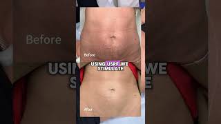 Noninvasive abdominal tightening [upl. by Levison]