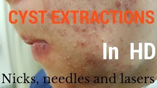 Cysts extractions blackheads  Removal methods in HD [upl. by Eidua]