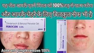 Acne pimple remove एक्ने पिंपल हटाने का सबसे बेस्ट जेल peroclin 25 gel acne pimple remove cream [upl. by Merlina919]