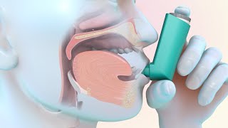 How to Use a MeteredDose Inhaler [upl. by Nyraf]