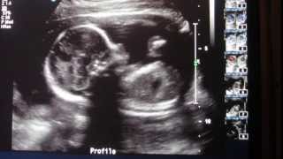 Cute amp Clear Ultrasound of baby Lucky  19 weeks ultrasound  anatomy scan [upl. by Inaniel]