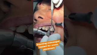 Exposing Submerged Implants for Crown Placement  shorts [upl. by Epp]