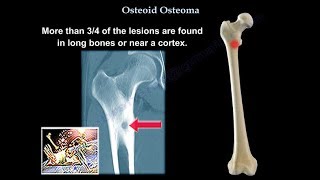 Osteoid Osteoma  Everything You Need To Know  Dr Nabil Ebraheim [upl. by Mikkanen]