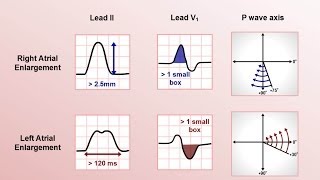 Intro to EKG Interpretation  Chamber Enlargement [upl. by Edda]